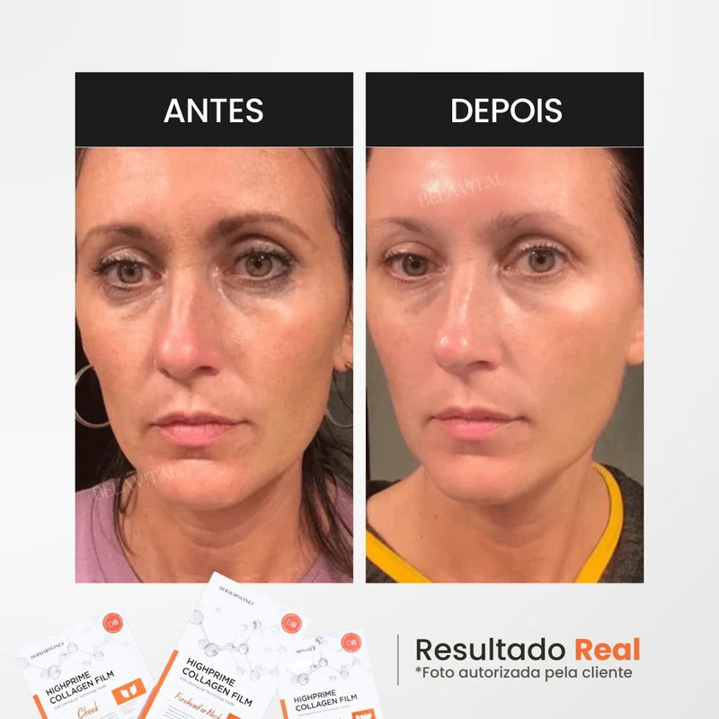 Kit  GoldBotox Highprime - Colágeno + Ácido Hialurônico [ATIVOS DO BOTOX]