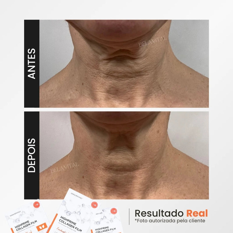 Kit  GoldBotox Highprime - Colágeno + Ácido Hialurônico [ATIVOS DO BOTOX]